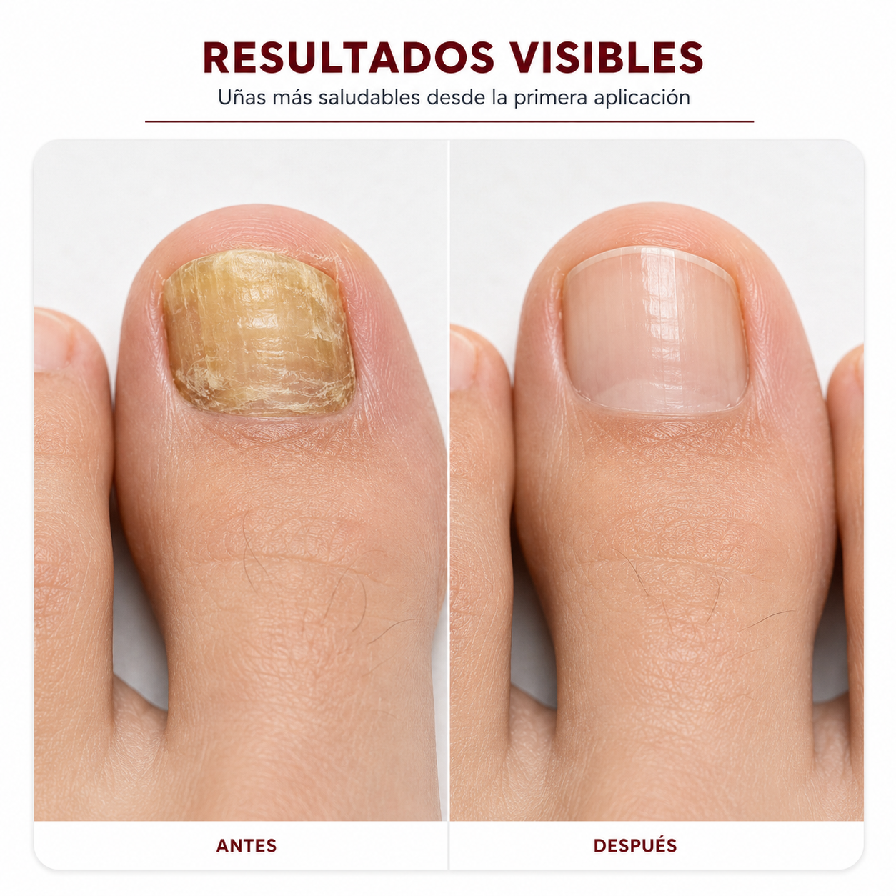 ClariNail™ - Lápiz reparador anti-hongos