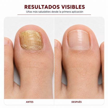ClariNail™ - Lápiz reparador anti-hongos