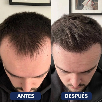 HairVive™ – Sérum Capilar Roll-On Anticaída