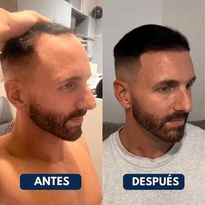 HairVive™ – Sérum Capilar Roll-On Anticaída